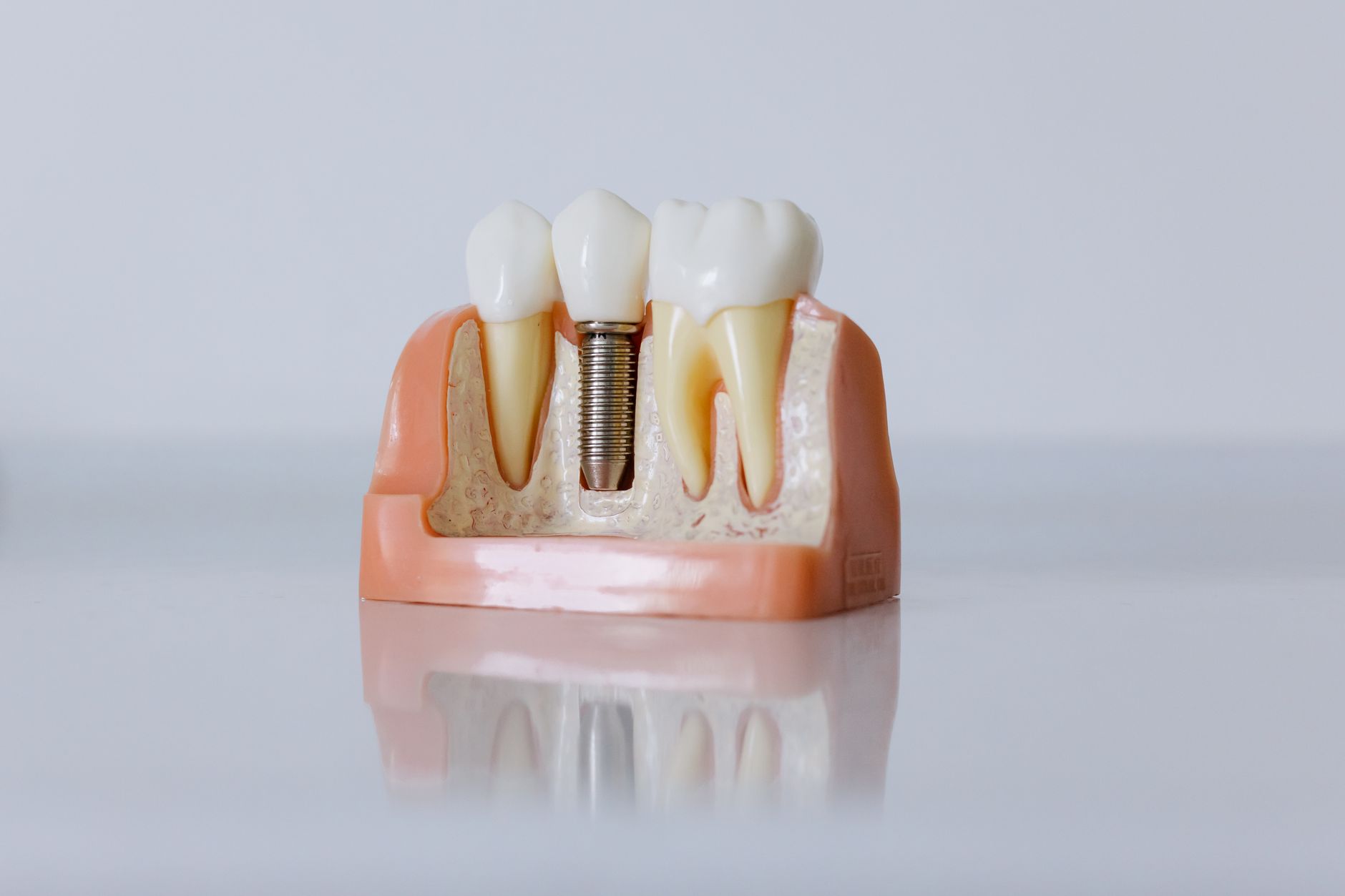 Skanery 3D w implantologii. Czemu cyfrowe planowanie zmienia grę w odbliegu zęba